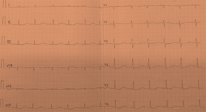 Baseline electrocardiography – Sinus bradycardia with prolonged QTc of 580 msec.